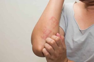 Menguak Fakta Medis Seputar Kulit Gatal Panduan Lengkap Untuk Memahami Pruritus